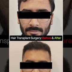 4100 Grafts Hair Transplant | Grade 3 Baldness Before & After Transformation