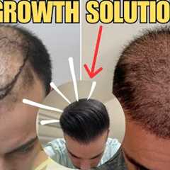 Hair Transplant No Growth- SOLUTION