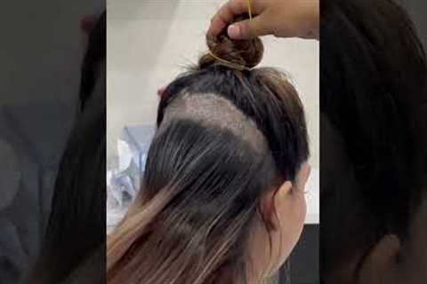Female hair transplant | Dadu Medical Centre | Dr. Nandni Daddu