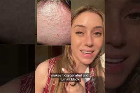 Best Ingredients for Acne Part 1 #shorts