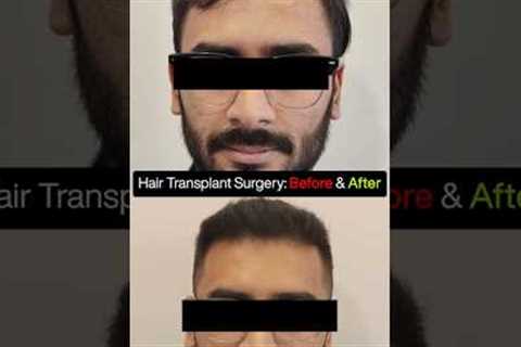 4100 Grafts Hair Transplant | Grade 3 Baldness Before &amp; After Transformation