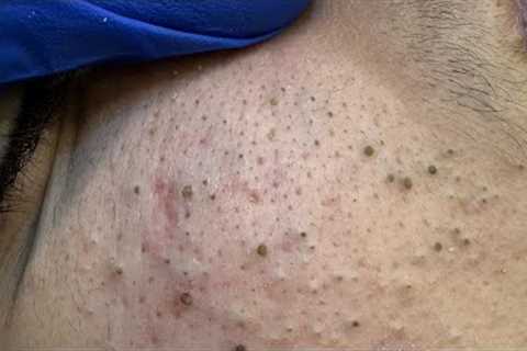 Deep Cleansing Routine | Acne Treatment &amp; Blackhead Removal