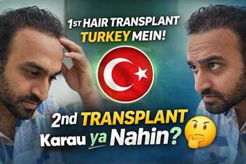 Hair Transplant in Kerala (HX-AWEU) | Best Results &amp; Cost of Hair Transplant in Kerala