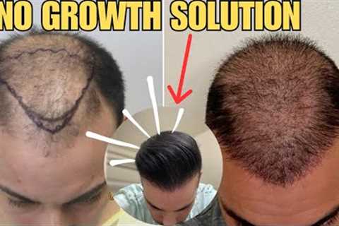 Hair Transplant No Growth- SOLUTION