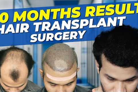 Hair Transplant Time Lapse  |  Step by Step Hair Transplant Surgery Time Lapse