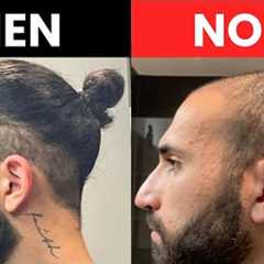 Bald after 2 Hair Transplants!