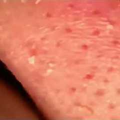 Deep Blackhead Extraction on the Nose | Relaxing ASMR Skin Care