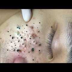 Deep Pore Blackhead Removal – Satisfying Acne Extraction & Relaxing Skincare - 234126