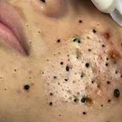 Calm Skincare Routine – Gentle Blackhead and Acne Cleaning - 219084