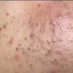 acne treatment deep pore cleansing & blackhead extraction[ASMR]