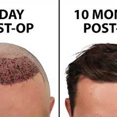 What a Hair Transplant Looks Like - Week By Week