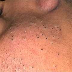 [ASMR] Clear Skin Therapy: Deep Cleansing and Pore Care