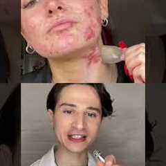 Pimple Patch Secret. #dermreacts #acne #skincare