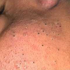 Tranquil Facial Care Routine for Acne & Skin Solutions - ASMR Cleansing