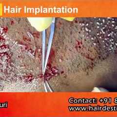 Hair Transplant Before & After Results | Real Patient Transformation | Natural Hair Regrowth