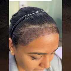 Female Hair Transplant Results | Day-by-Day Progress