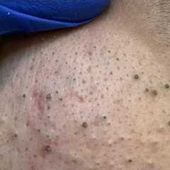 Deep Pore Cleansing | Acne Treatment & Blackhead Removal Routine