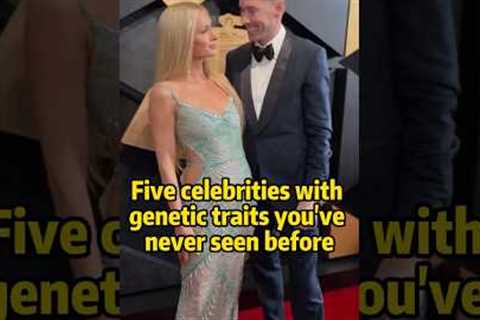 Five celebrities with genetic traits you’ve never seen before #celebrity #news #billieeilish