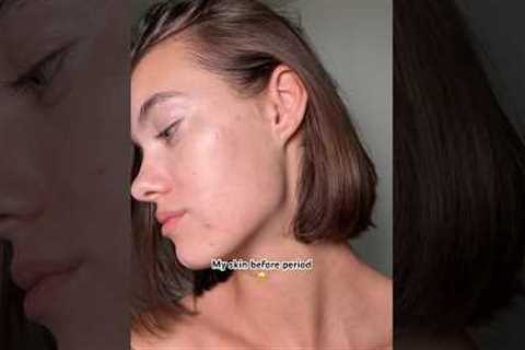 Skin before period 🥹😳#acneproneskin #acne #skincare #skincaretips #noncomedogenic #acnetreatment