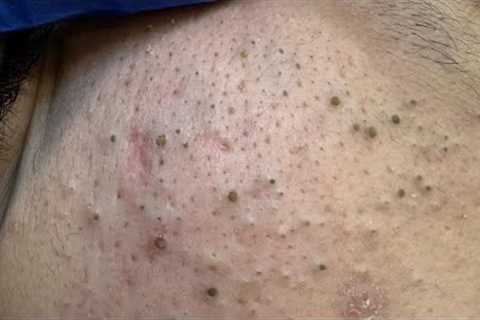 ULTIMATE Blackhead Removal Routine | Korean Facial Care Solutions