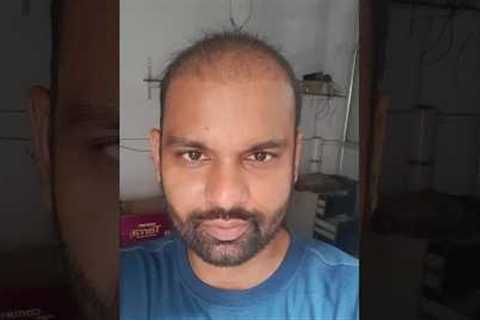 Hair Transplant 2 month result | Day1 to Day 60 Hair Transplant Timelapse | Rajan Singh