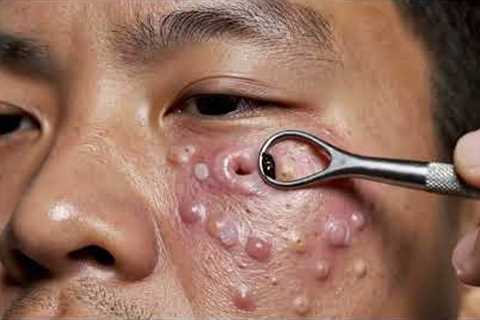 Blackhead Removal on Oily Skin | Deep Pore Cleaning