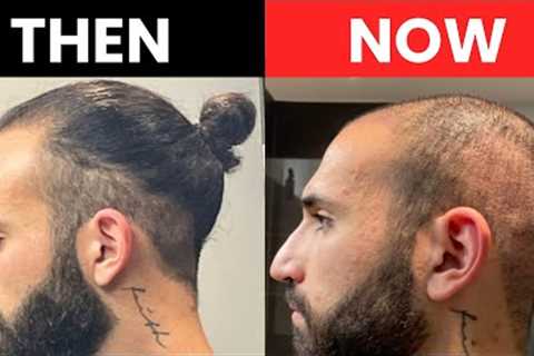 Bald after 2 Hair Transplants!