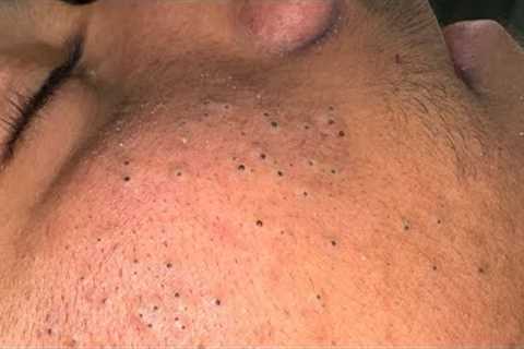 Tranquil Skin Therapy ASMR — Effective Solutions for Blackheads and Acne