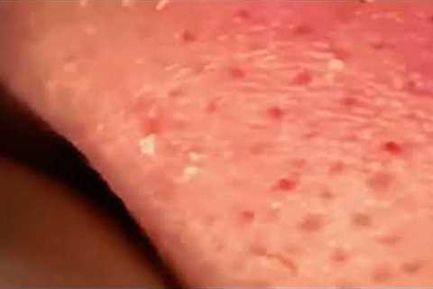 Deep Blackhead Extraction on the Nose | Relaxing ASMR Skin Care