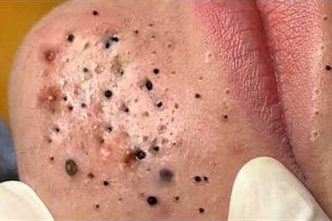 Calm Skincare Routine – Gentle Blackhead and Acne Cleaning - 219083