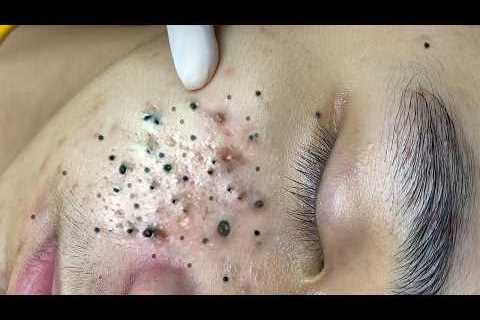 Deep Pore Blackhead Removal – Satisfying Acne Extraction &amp; Relaxing Skincare - 234126