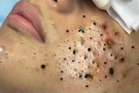 Calm Skincare Routine – Gentle Blackhead and Acne Cleaning - 219084