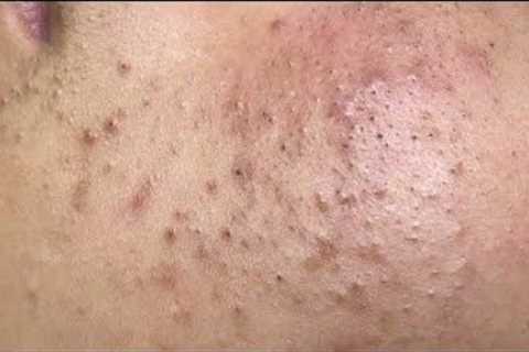acne treatment deep pore cleansing & blackhead extraction[ASMR]