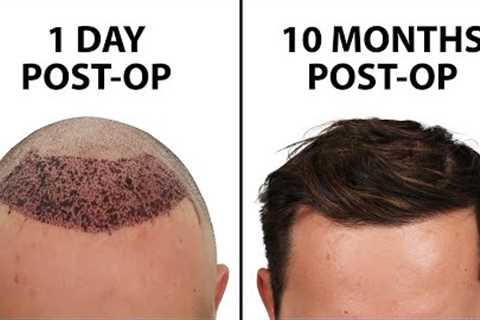 What a Hair Transplant Looks Like - Week By Week