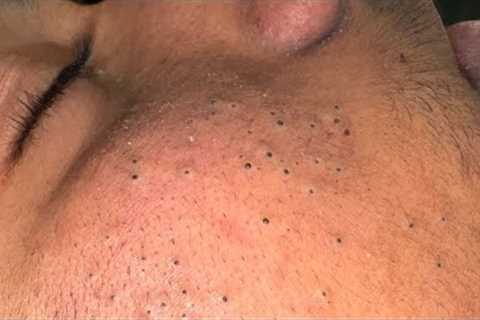 [ASMR] Clear Skin Therapy: Deep Cleansing and Pore Care