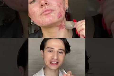 Pimple Patch Secret. #dermreacts #acne #skincare