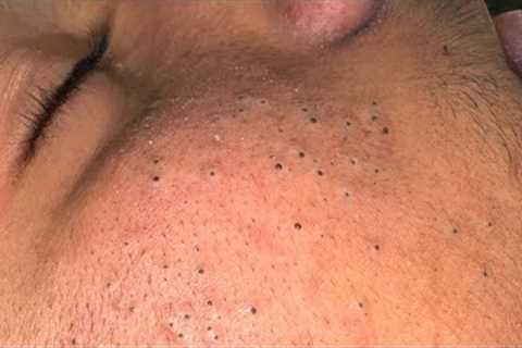 Tranquil Facial Care Routine for Acne & Skin Solutions - ASMR Cleansing