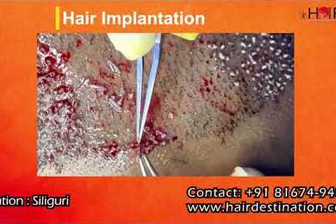 Hair Transplant Before &amp; After Results | Real Patient Transformation | Natural Hair Regrowth