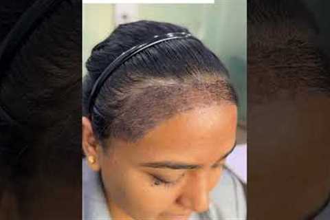 Female Hair Transplant Results | Day-by-Day Progress