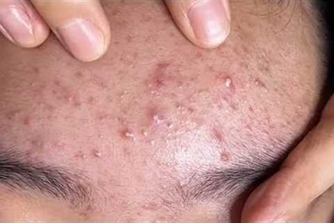 ASMR Deep Facial Cleansing &amp; Blackhead Removal#acne 