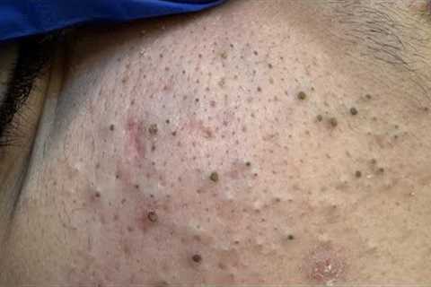 Deep Pimple Cleansing | Acne Treatment &amp; Facial Care Routine