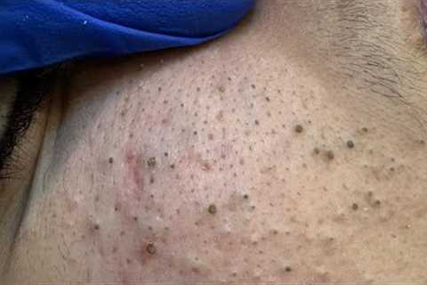 Deep Pore Cleansing | Acne Treatment &amp; Blackhead Removal Routine