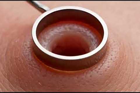 Satisfying Blackhead Removal Compilation | Deep Pore Cleaning ASMR Extreme Blackhead Extraction