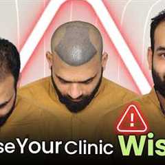 Hair Transplant in Surat (HX-IQPO) | Best Results & Cost of Hair Transplant in Surat.
