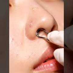 Pure Glow ASMR | Gentle Whitehead Extraction & Deep Skin Cleaning Therapy 🌿💆‍♀️😌..