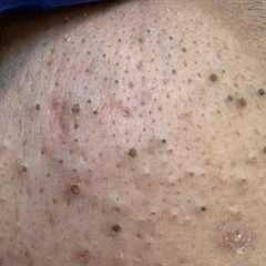 ASMR Facial Care Routine - Deep Cleansing, Pimple Treatment, and Blackhead Removal