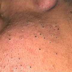 ASMR Facial Care Routine for Clear Skin - Deep Cleansing, Blackhead Removal & Pimple Treatment