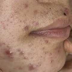 pimple popper blackhead remove,#001 