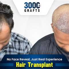 Grade 3 Hair Transplant in India | Hair Transplant Results & Cost in India #hairtransformation
