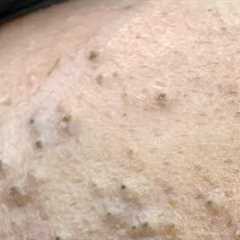 ASMR Facial Care Routine for Acne-Free Skin - Deep Cleansing & Natural Remedies